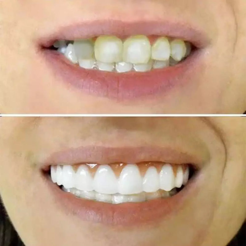 Dentadura NewSmile - Compre 1 Leve 3 - Site Oficial de Vendas